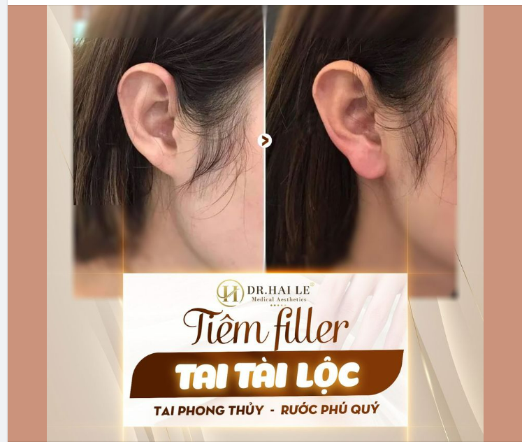 Tiêm filler tai tài lộc - Thay đổi nhỏ nhưng lại tạo ra phúc khí lớn