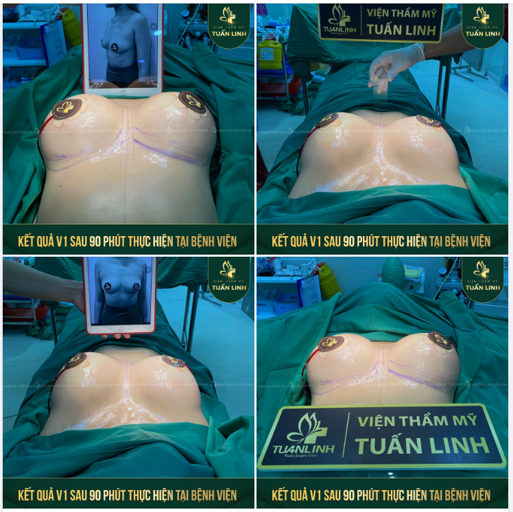 TIẾP TỤC HOÀN THÀNH CA NÂNG V1 TẠI BỆNH VIỆN