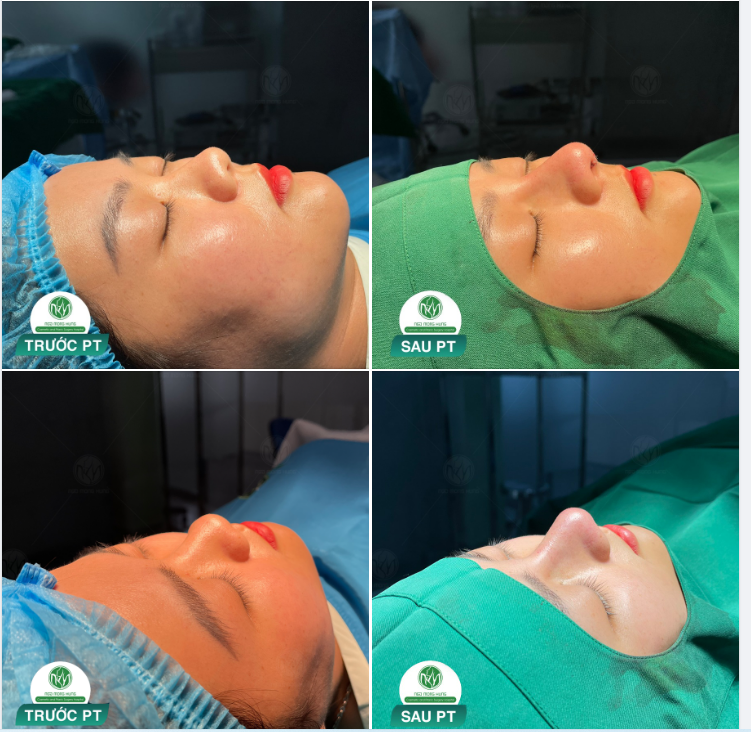 TIẾP TỤC LÀ MỘT CA NÂNG MŨI S LINE NỮA