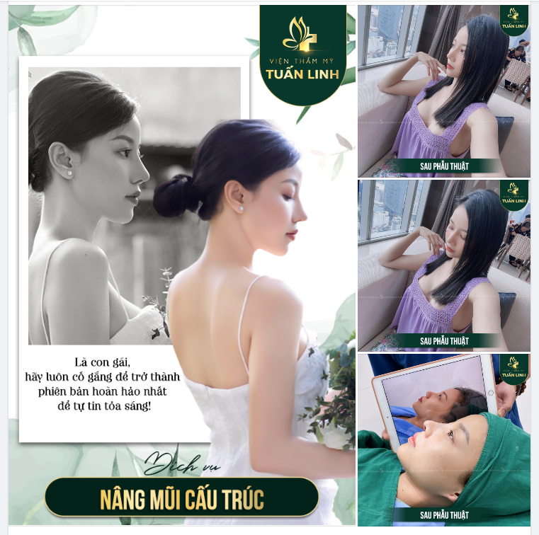 TỎA SÁNG XINH ĐẸP VỚI NÂNG MŨI CẤU TRÚC