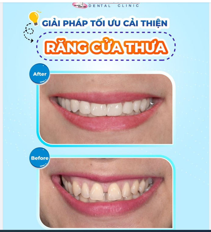 “Tôi đã từng stress vì nụ cười của mình”
