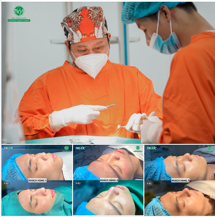 TỔNG HỢP MỘT VÀI CA NÂNG MŨI NAM TẠI BỆNH VIỆN