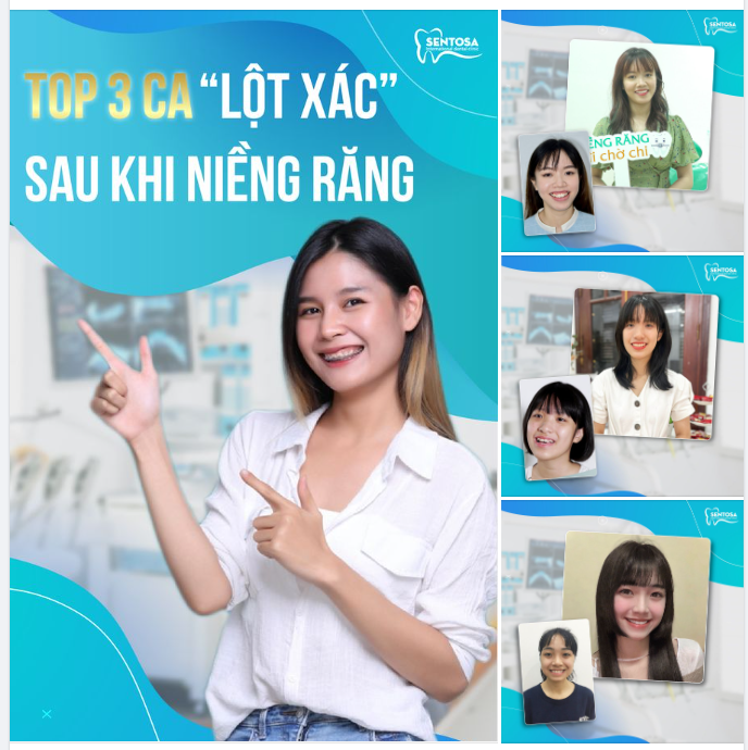 TOP 3 CA NIỀNG RĂNG KHẤP KHỂNH THÀNH CÔNG TẠI UP DENTAL