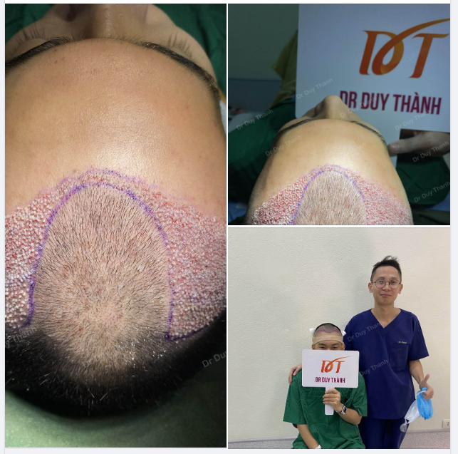 Trả kết quả cấy 1500 nang tóc cho anh zai 29 tuổi.