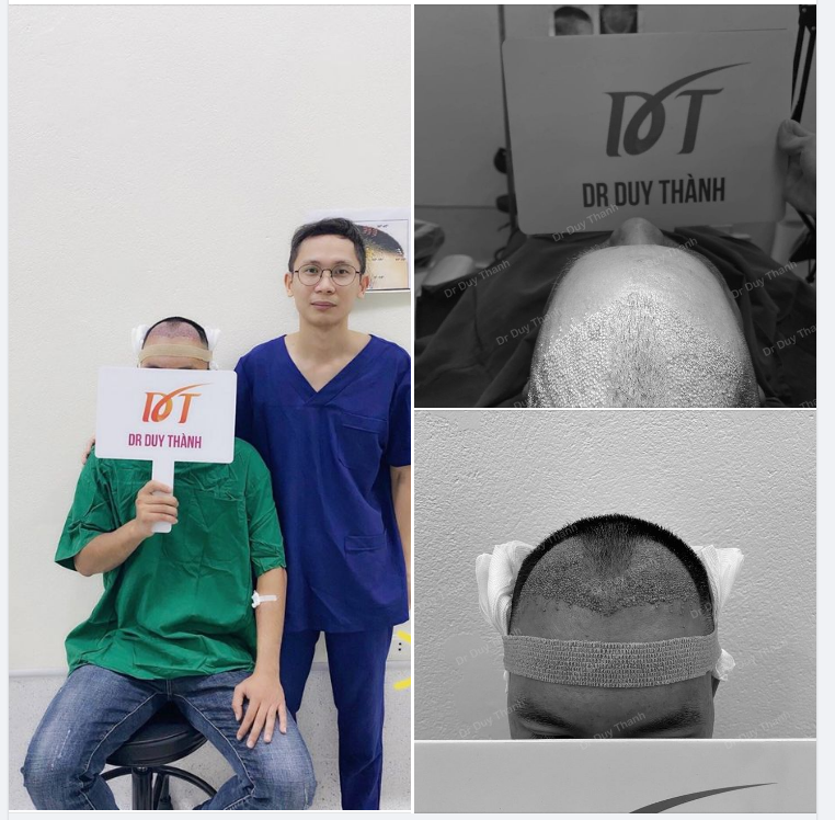 TRẢ KẾT QUẢ CẤY TÓC 1500 NANG CHO BOY ĐỒNG NAI 30 TUỔI