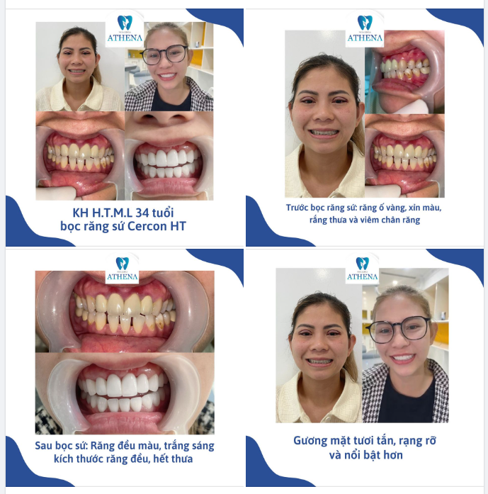 TRẺ HÓA GƯƠNG MẶT NHỜ LÀM RĂNG SỨ CRECON HT