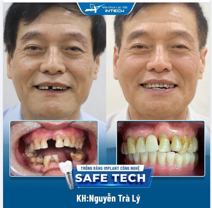 TRẺ HƠN, ĂN NHAI TỐT HƠN, TỰ TIN HƠN NHỜ TRỒNG RĂNG IMPLANT
