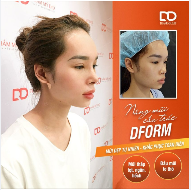 TRẺ HƠN - ĐẸP HƠN KHI NÂNG MŨI CẤU TRÚC DFORM KẾT QUẢ 10 NGÀY PHẪU THUẬT NÂNG MŨI CẤU TRÚC