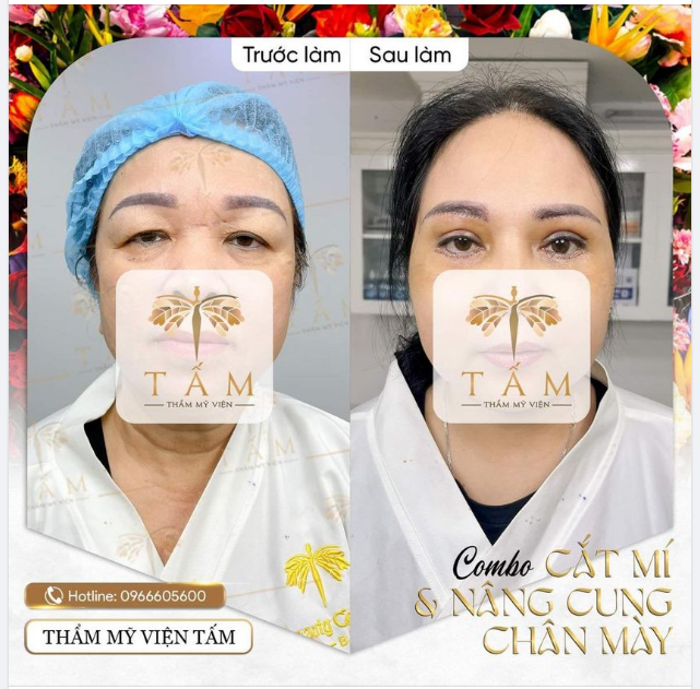 TRẺ RA 10 TUỔI - COMBO CẮT MÍ NÂNG CUNG CHÂN MÀY