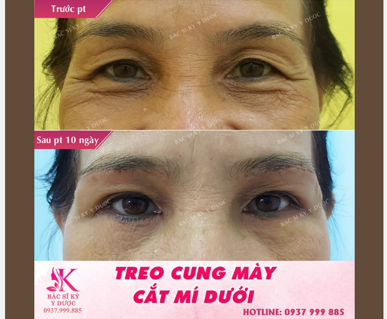 Treo cung mày kết hợp cắt mí mắt dưới. Hồi xuân cho đôi mắt