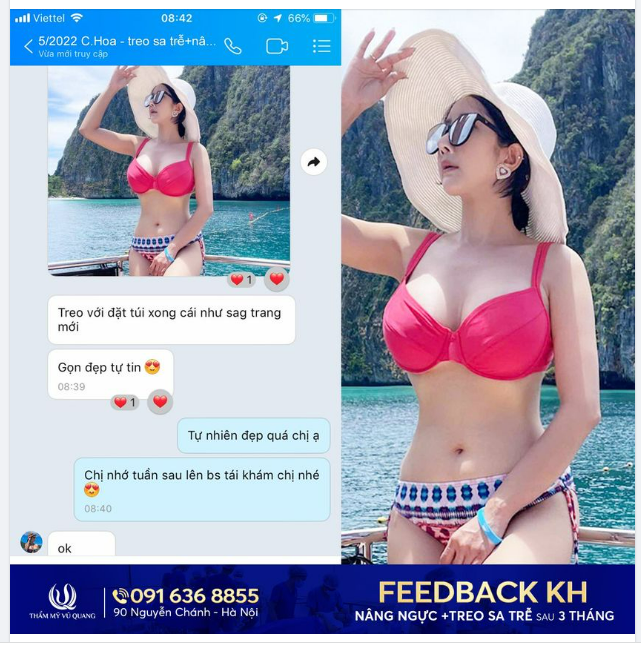 Treo ng ực chảy xệ - Lấy lại thanh xuân