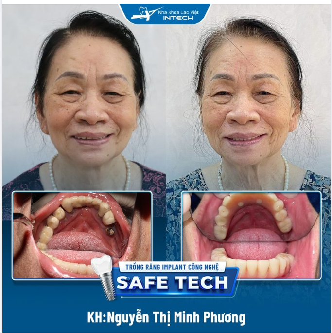 TRỒNG RĂNG IMPLANT ALL ON 4 – KHÔI PHỤC MẤT RĂNG TOÀN HÀM DƯỚI