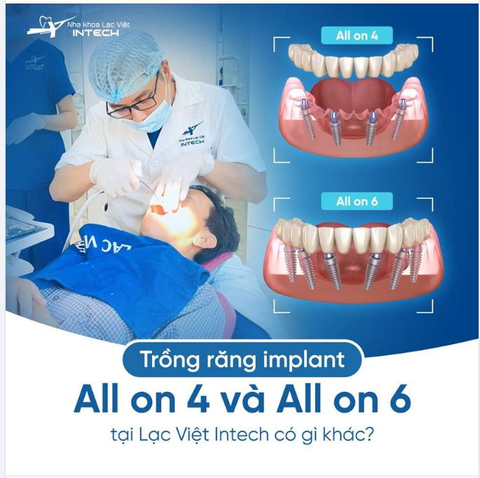 TRỒNG RĂNG IMPLANT ALL ON 4 VÀ ALL ON 6 TẠI LẠC VIỆT INTECH CÓ GÌ KHÁC?