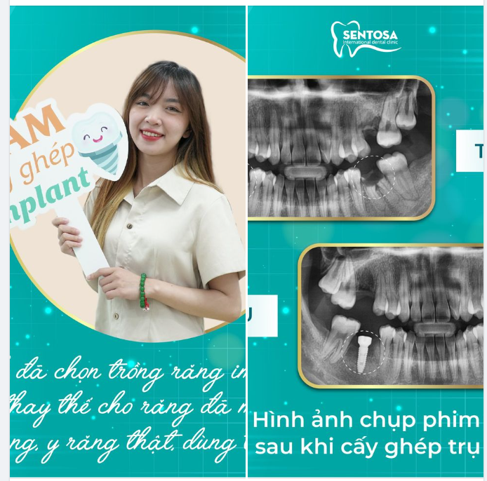 TRỒNG RĂNG IMPLANT - GIẢI PHÁP HOÀN HẢO CHO NGƯỜI TRẺ TUỔI