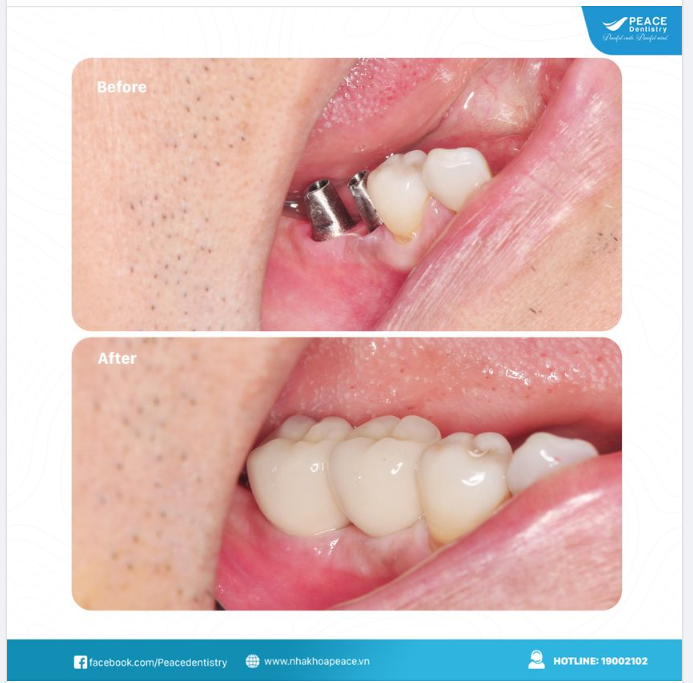  Trồng răng implant giải pháp phục hình răng tối ưu