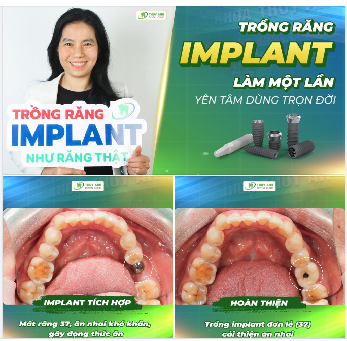 TrỒng RĂng Implant KhẮc PhỤc HẬu QuẢ Do MẤt RĂng ĐỂ LẠi 