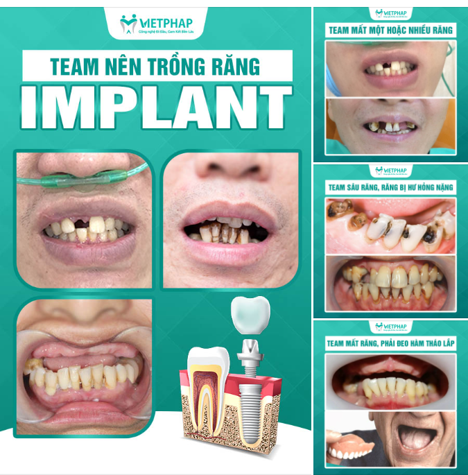 TRỒNG RĂNG IMPLANT NGAY NẾU NHƯ BẠN THUỘC TEAM NÀY