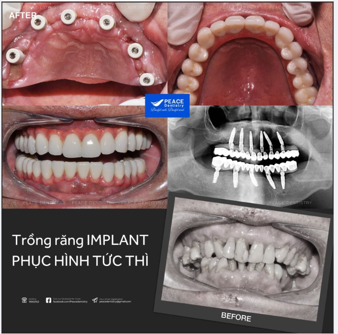 TRỒNG RĂNG IMPLANT PHỤC HÌNH TỨC THÌ