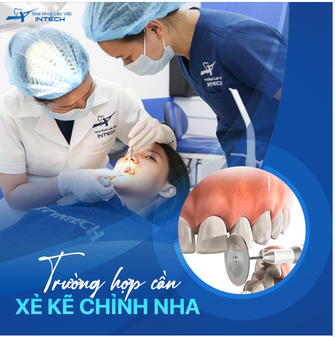 TRƯỜNG HỢP CẦN XẺ KẼ RĂNG CHỈNH NHA