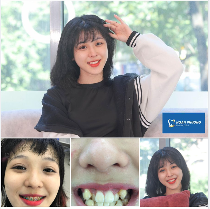 Tự tin "bật" cá tính với chun chỉnh nha 7 sắc cầu vồng