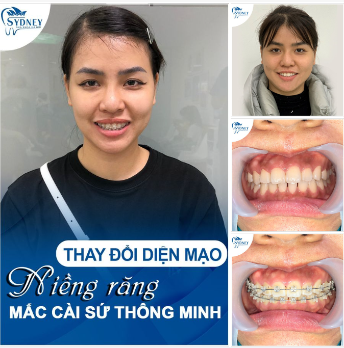 TỰ TIN HƠN KHI NIỀNG RĂNG MẮC CÀI SỨ!