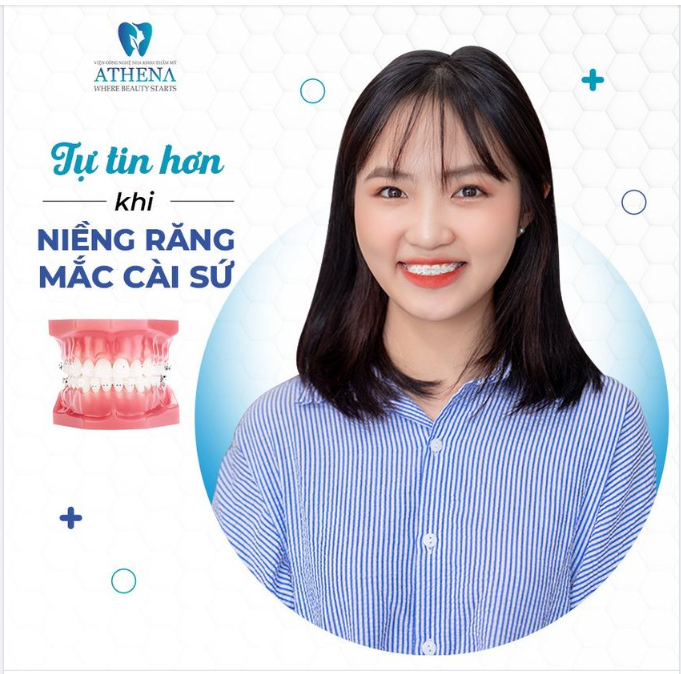 TỰ TIN HƠN KHI NIỀNG RĂNG MẮC CÀI SỨ!