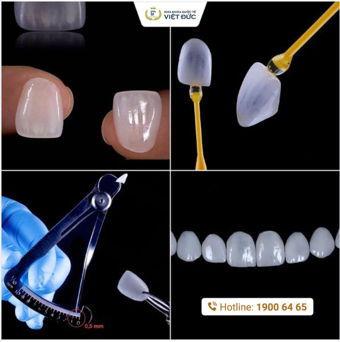 VẺ ĐẸP DÁN SỨ VENEER SIÊU MỎNG