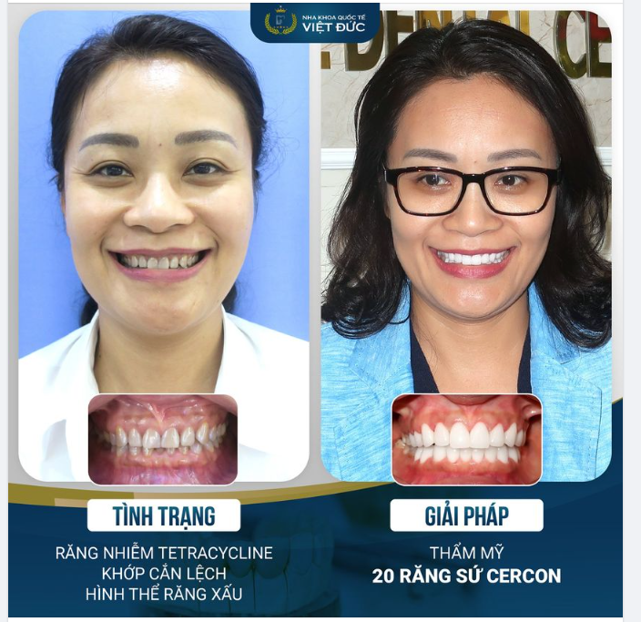 VẺ ĐẸP SỨ CERCON TRÊN NỀN RĂNG NHIỄM TETRACYCLINE
