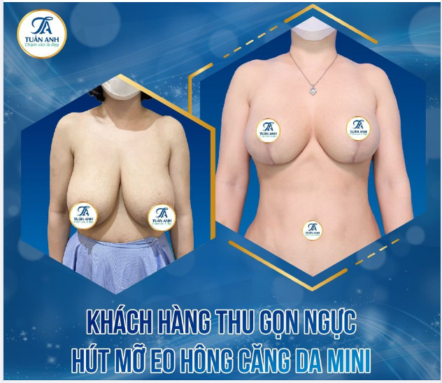 Vì sao nói ngực phì đại, sa trễ nặng là bệnh lý vùng ngực, cần can thiệp sớm