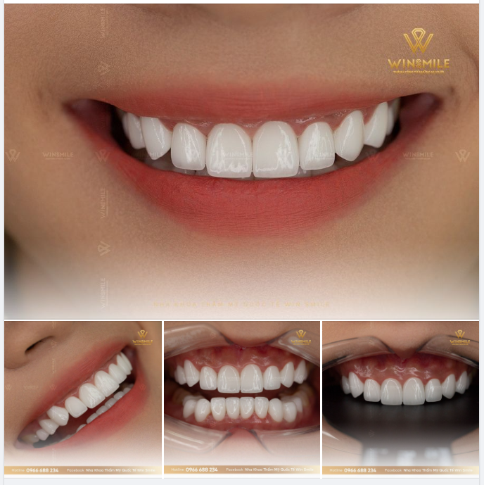 VÌ SAO RĂNG SỨ LAVA 3M ĐƯỢC NHIỀU NGHỆ SĨ LỰA CHỌN?