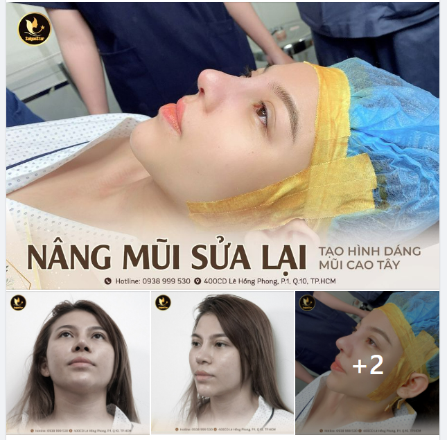 VIỆT KIỀU MALAYSIA VỀ VIỆT NAM NÂNG MŨI SỬA LẠI TẠO HÌNH DÁNG MŨI CAO TÂY