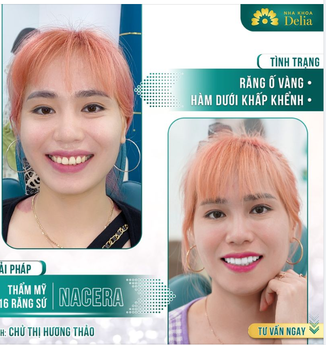 Việt Kiều về nước bọc răng sứ và cái kết sau 2 lần hẹn