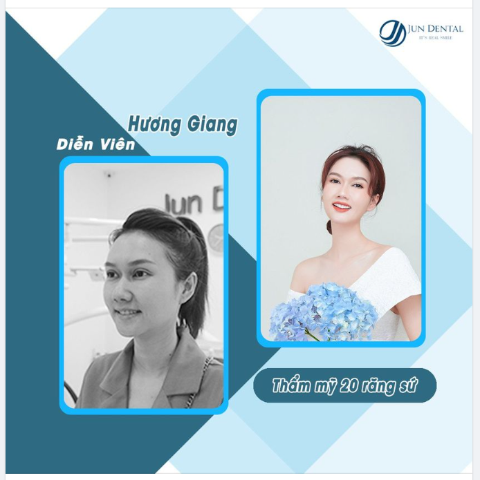 ​​​​​​​Với sự ra đời của công nghệ bọc răng sứ không cần mài răng Minish Laminate khi sử dụng miếng dán sứ siêu mỏng với độ dày khoảng 0,2 – 0,3 mm, hạn chế tối đa việc mài răng mất kiểm soát và giúp răng gốc được bảo tồn gần như 100%.