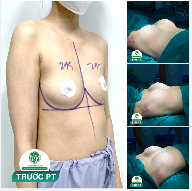 VÒNG 1 ĐẦY ĐẶN HƠN SAU NÂNG NGỰC