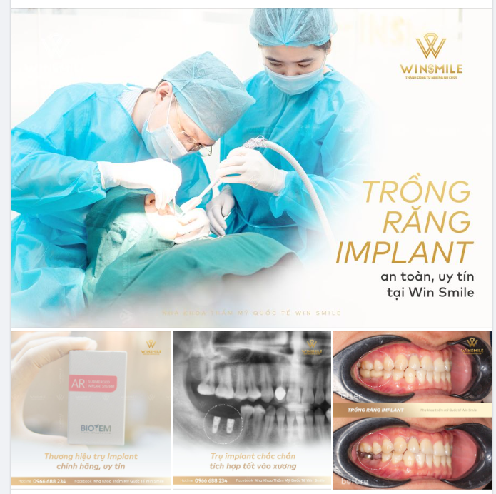 WIN SMILE GIÚP BẠN CHẤM DỨT NỖI KHỔ MẤT RĂNG