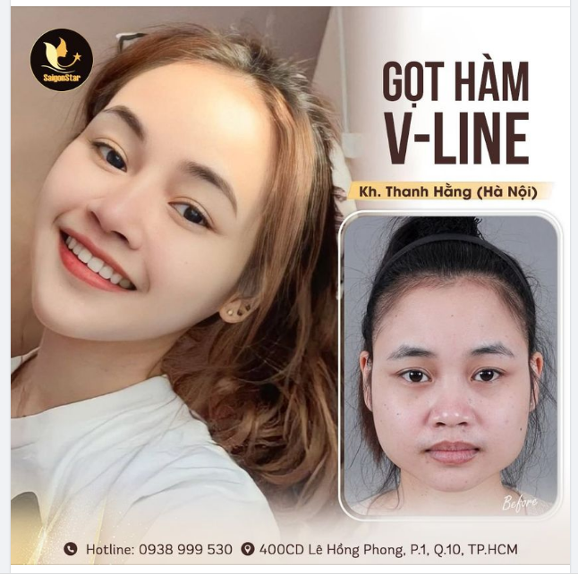 Wow! Feedback cực xịn sò của bạn Thanh Hằng GỌT HÀM sau 1 tháng nè cả nhà ơi