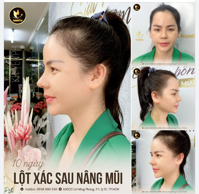 WOW! NHAN SẮC HOÀN TOÀN LỘT XÁC SAU 10 NGÀY NÂNG MŨI