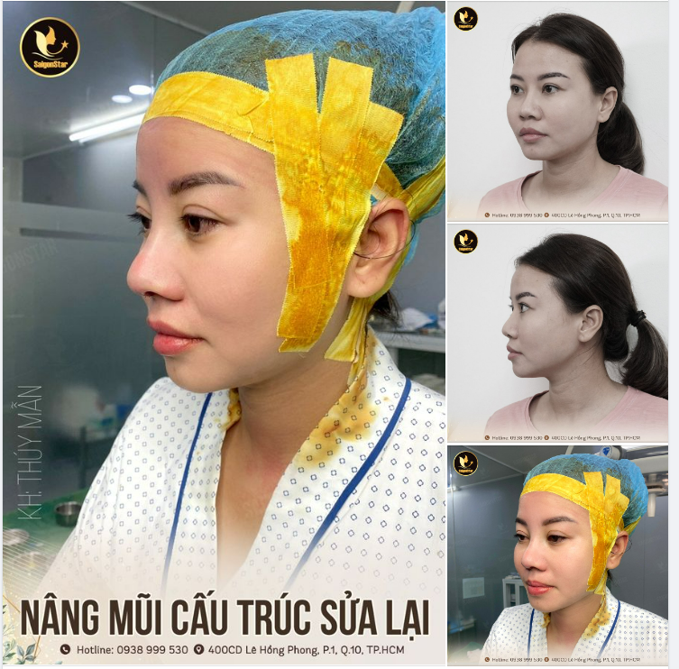 Xinh đẹp ngay sau khi nâng mũi