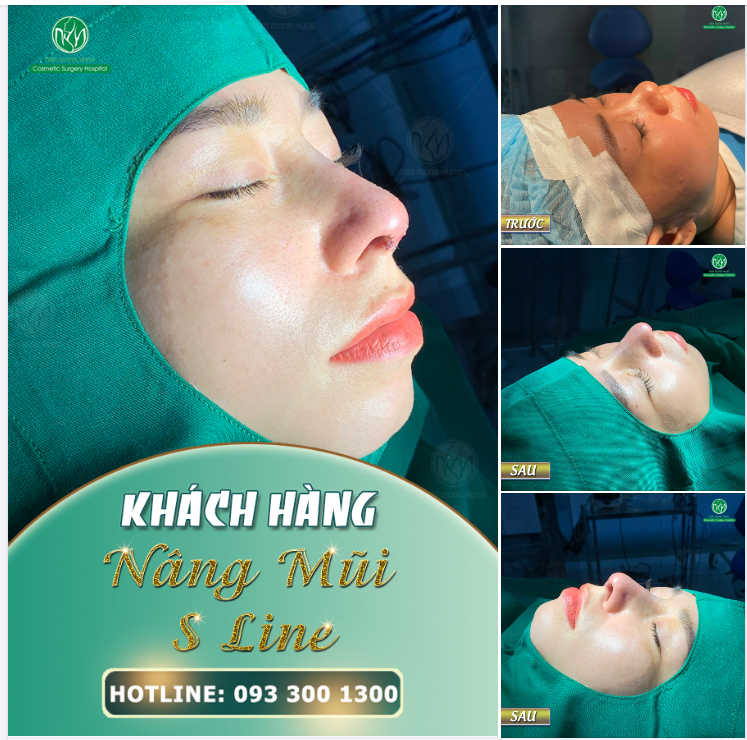XÓA BỎ MỌI KHUYẾT ĐIỂM VỚI DÁNG MŨI S LINE