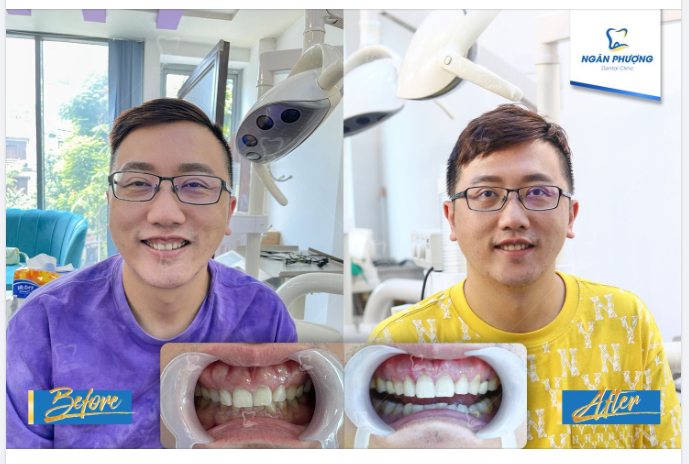 Xử lý phần thừa, tái tạo đường cười tự tin cho anh khách Đài Loan