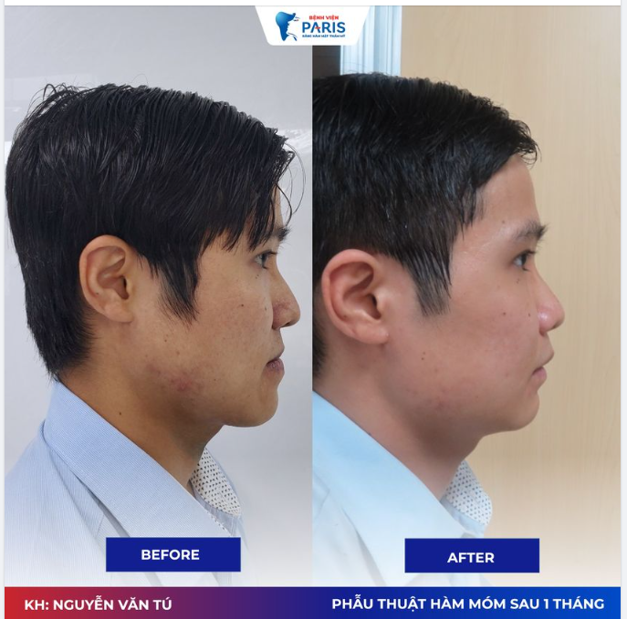 Xương hàm dưới quá phát - Ăn uống bất tiện