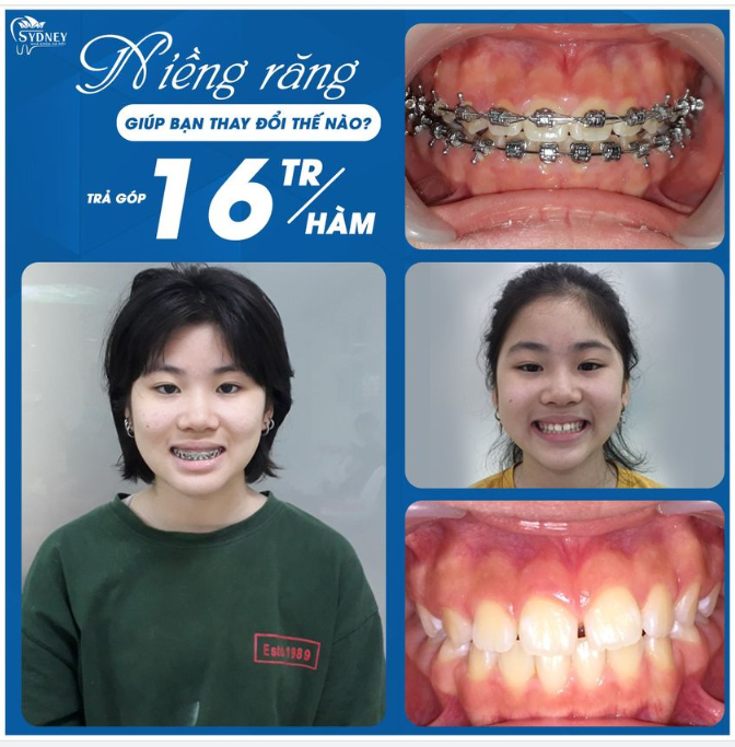 YẾU TỐ GIÚP NIỀNG RĂNG LÀM THAY ĐỔI KHUÔN MẶT
