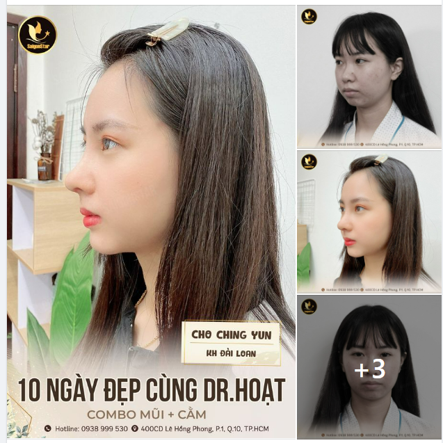 10 NGÀY HOÀN THIỆN SẮC DIỆN CÙNG KHÁCH HÀNG ĐÀI LOAN COMBO NÂNG MŨI + ĐỘN CẰM