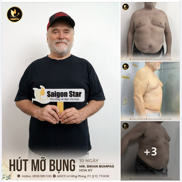 10 NGÀY HÚT MỠ BỤNG  MR. BRIAN BUMPAS (HOA KỲ)