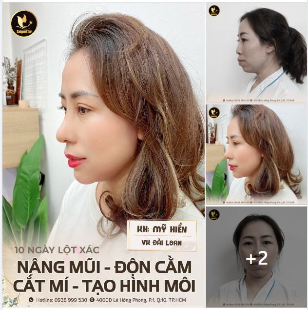 10 NGÀY LỘT XÁC CÙNG KHÁCH HÀNG VIỆT KIỀU ĐÀI LOAN NÂNG MŨI + ĐỘN CẰM + CẮT MÍ + TẠO HÌNH MÔI