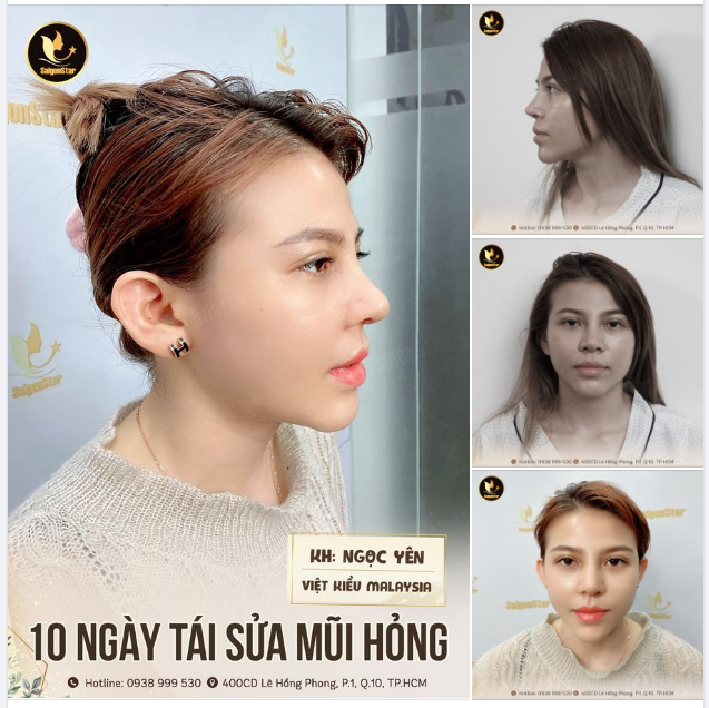 10 NGÀY TÁI SỬA MŨI HỎNG CHO KHÁCH VIỆT KIỀU MALAYSIA