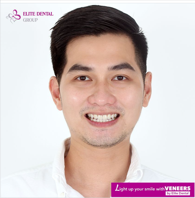 16 VENEER HOÀN THIỆN NỤ CƯỜI SAU CHỈNH NHA