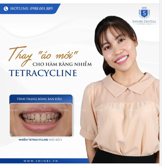 20 RĂNG SỨ ĐỔI LẠI NỤ CƯỜI THẨM MĨ