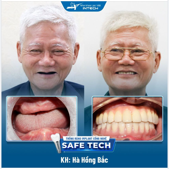 25 NĂM MẤT RĂNG VÀ ĐIỀU ƯỚC TUỔI XẾ CHIỀU