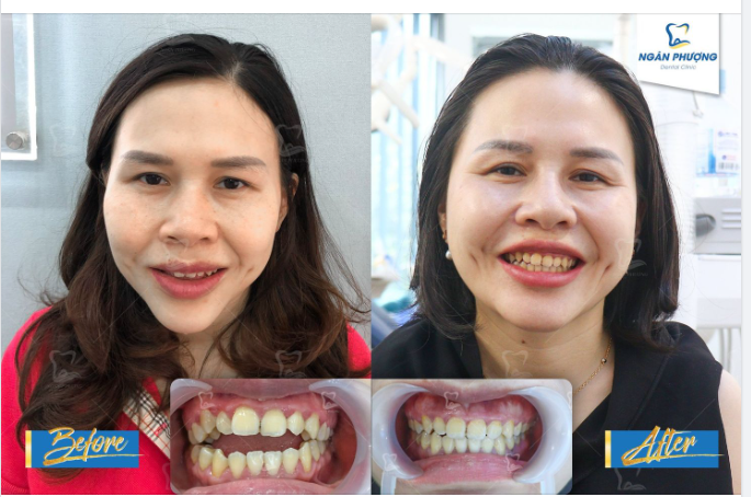 30 chị chẳng ngại ngần - Chỉnh nha một chút thêm phần tự tin